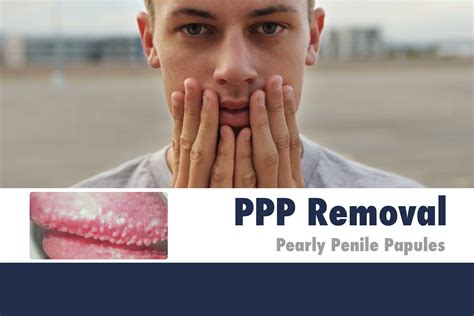 PPP: Pearly Penile Papules Facts and Treatment